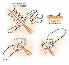 vertical mattress suturing results in
