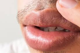 fordyce spots on the lips causes