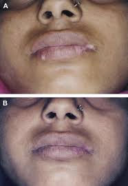 treatment of lip vigo