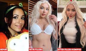 Model who spent $15,000 on filler gets it all dissolved after forgetting  what her face looked like 