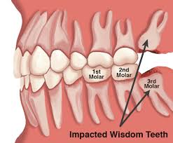 inflamed gums from wisdom teeth