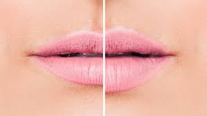 It uses 6.5 bar of pressure, in nanoscale small molecules 220 nano meters per second. Lip Fillers How Long Do They Last How Much Do They Cost And Everything Else You Need To Know Closer
