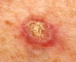 Thank you, {{form.email}}, for signing up. Skin Cancer And Precancerous Skin Lesions What You Need To Know Skin Enhance And Wellness
