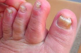 toenail fungus causes treatments