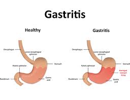Best Gastritis Diet Foods To Eat And Avoid