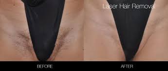brazilian laser hair removal in toronto