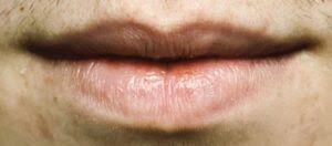lip cancer not uncommon often