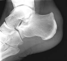 Haglund syndrome characterised by a prominent posterior bursal projection of calcaneum, achilles tendinosis v.the haglund syndrome: Haglund Syndrome Radiology Reference Article Radiopaedia Org