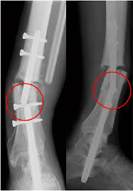 broken intramedullary nail at 16 months