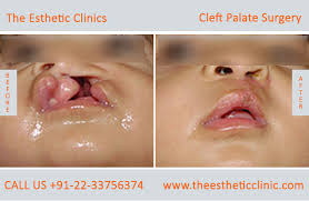 best cleft palate treatment in mumbai