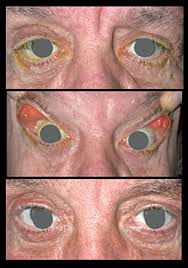 cataract surgery the oculoplastic factor