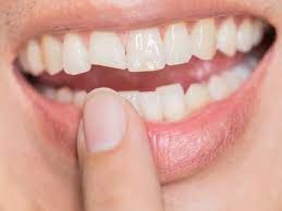 Innan du bleker tänderna | Missfärgade tänder