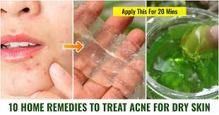 treat acne for dry skin