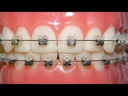 A common question we always get is do braces hurt? in this video, dr jenny zhu will answer the question and provide some pain management tips on how to. Getting Braces Do They Hurt Youtube