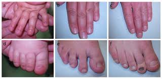 con nail disorders