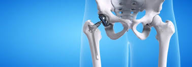 common signs you need a hip replacement