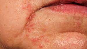 fatty liver symptoms on your face and