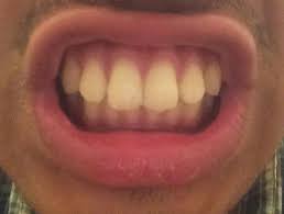 People need braces for different reasons, which also means there are different types of braces. Are My Teeth Overbite Should I Get Braces Braces