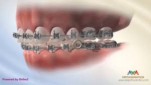 This is how rubber bands work on braces. How To Wear Rubber Bands Crossbite Upper 6 Lower 6 Youtube