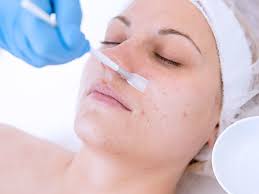 Chemical peels: Do they work?