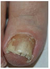 jof free full text onychomycosis a