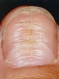 what are the white spots on your nails