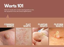 warts signs symptoms dermatology