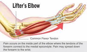 how i fixed my lifter s elbow