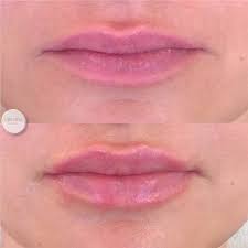 lip injections in denver co plump