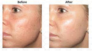 Do not do a microneedling session too often since it takes time for skin to heal and recover. Microneedling Washington Institute