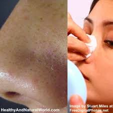 get rid of whiteheads and blackheads