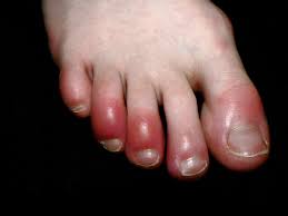 mysterious wave of covid toes still has