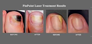laser treatment for nail fungus an