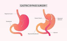 gastric byp risks obesity surgery