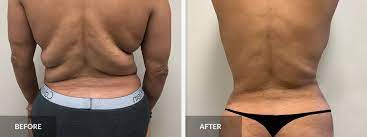how much does liposuction cost south