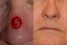 skin cancer and mohs repair for men