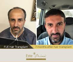 At the 6 month stage, some doctors will check in with you online or in person to analyse your recovery and growth. Pin On Hair Transplant
