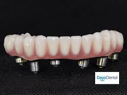 Denture Implants Vs Fixed Bridge Teeth Replacement Options