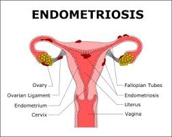 First known use of endometriosis. What Is Endometriosis Obstetrical And Gynecological Services In Houston Tx