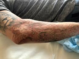 The timeline of this treatment varies greatly from person to person, but most patients need between six and twelve sessions to completely remove a tattoo. 10 Things You Should Know About Laser Tattoo Removal Lead The Followers