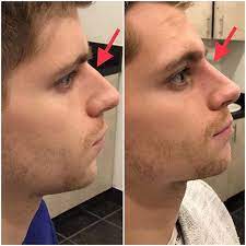 reshape your nose without surgery