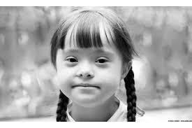 Down syndrome continues to be the most common chromosomal disorder. Down Syndrome Awareness Dispel The Misconceptions