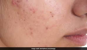 home remes for pimples blackheads
