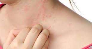 tips to deal with an itchy skin rash