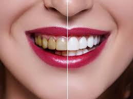 teeth whitening ista clinica