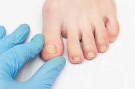 most common toenail problems the