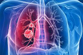 Cancer Screening guidelines for Lung Cancer Cancer – Sankalp Beautiful World