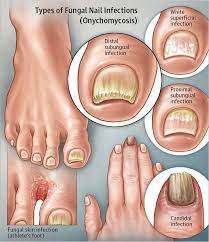 fungal toenail infections foot power