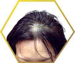 post menopausal hair loss causes