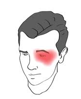 Clusterhoofdpijn is een vrij ernstige vorm van hoofdpijn. Clusterhoofdpijn Optimum Zoetermeer